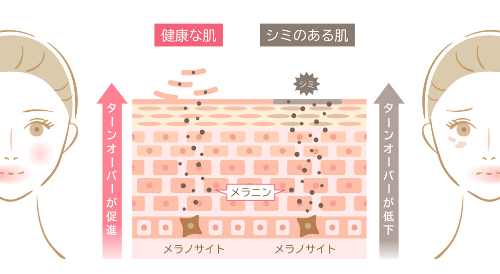 しみ肌のターンオーバー｜脱毛＆光サロンone-shot(ワンショット) 徳島市の脱毛＆光エステサロン