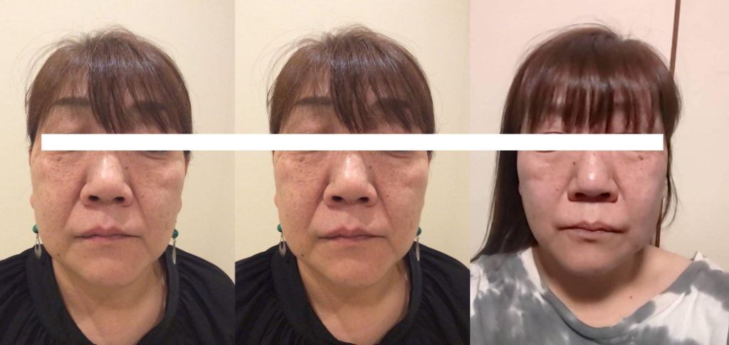 光エステ(フォト)施術例｜50代女性｜脱毛＆光サロンone-shot(ワンショット) 徳島市の脱毛＆光エステサロン