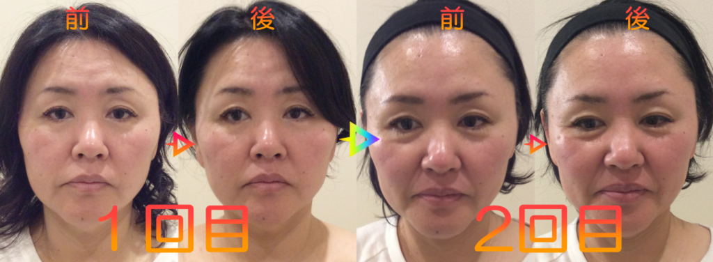 光エステ(フォト)施術例｜50代女性｜脱毛＆光サロンone-shot(ワンショット) 徳島市の脱毛＆光エステサロン