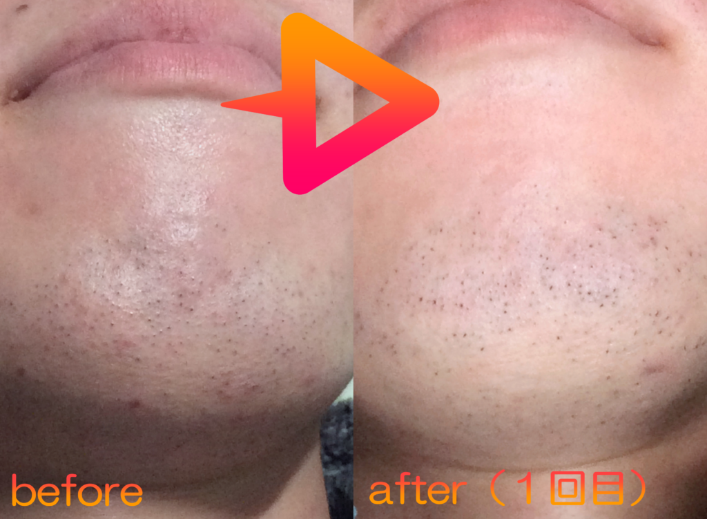 脱毛施術例｜20代男性ヒゲ脱毛｜one-shot(ワンショット) 徳島市の脱毛＆光エステサロン