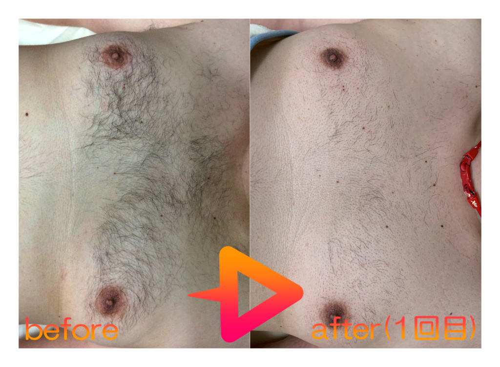 脱毛施術例｜40代男性胸脱毛｜one-shot(ワンショット) 徳島市の脱毛＆光エステサロン