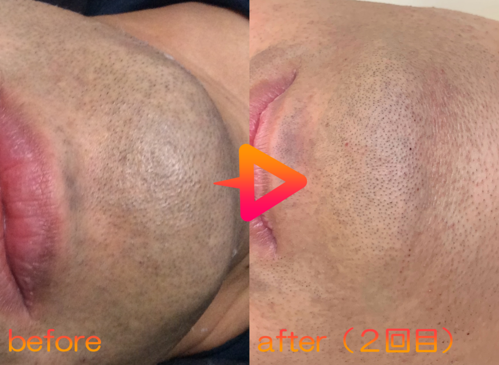 脱毛施術例｜40代男性ヒゲ脱毛｜one-shot(ワンショット) 徳島市の脱毛＆光エステサロン