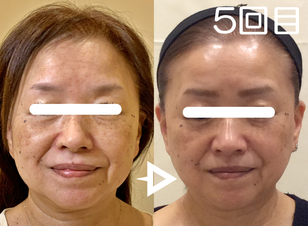 光エステ(フォト)施術例｜50代女性脱毛＆光サロンone-shot(ワンショット) 徳島市の脱毛＆光エステサロン