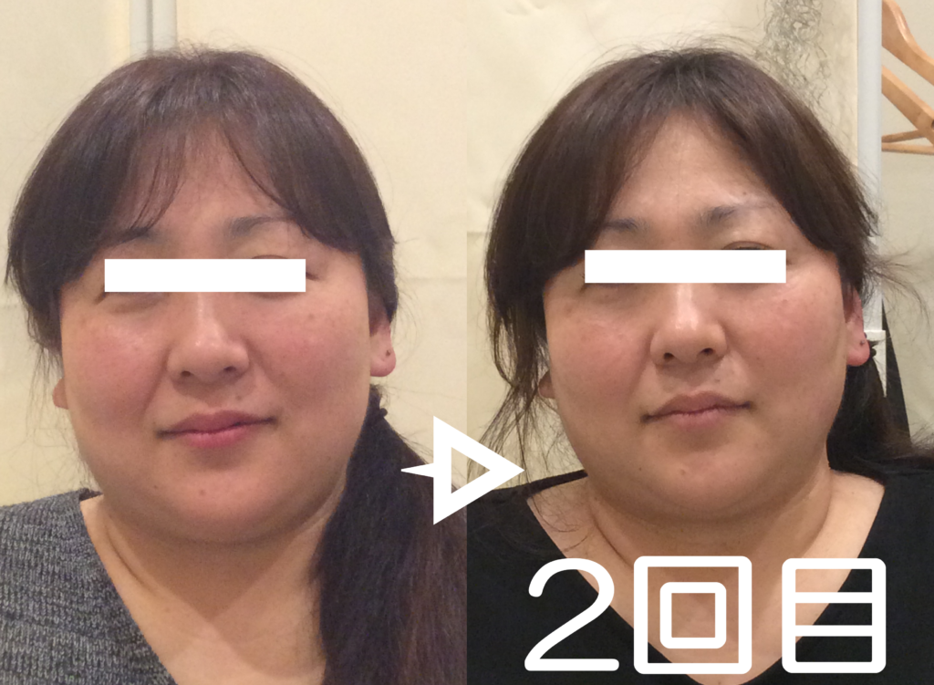 光エステ(フォト)施術例｜40代女性｜脱毛＆光サロンone-shot(ワンショット) 徳島市の脱毛＆光エステサロン