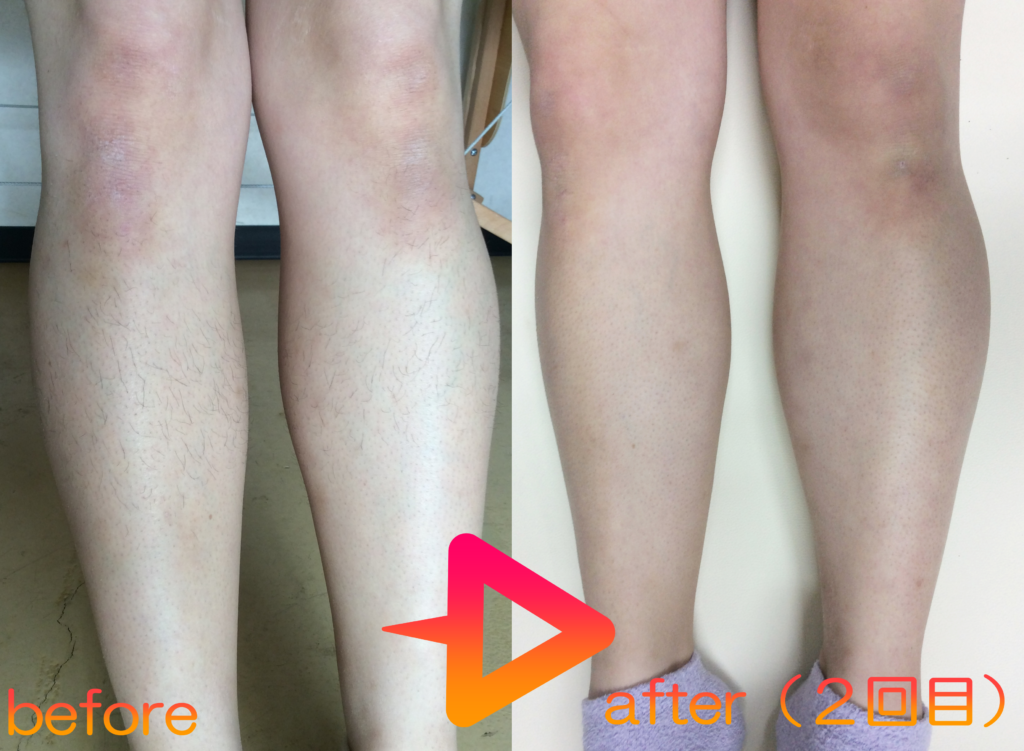 脱毛施術例｜20代女性足脱毛｜one-shot(ワンショット) 徳島市の脱毛＆光エステサロン