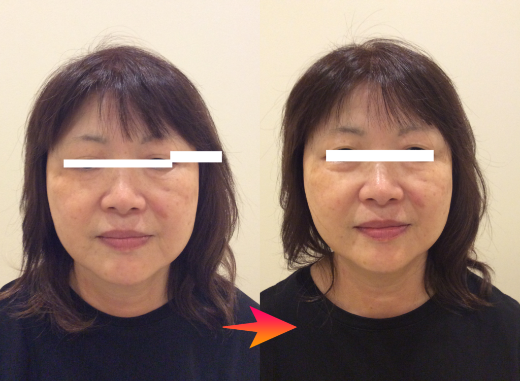 光エステ(フォト)施術例｜50代女性｜脱毛＆光サロンone-shot(ワンショット) 徳島市の脱毛＆光エステサロン