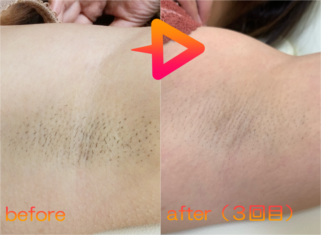 脱毛施術例｜20代女性ワキ脱毛｜one-shot(ワンショット) 徳島市の脱毛＆光エステサロン