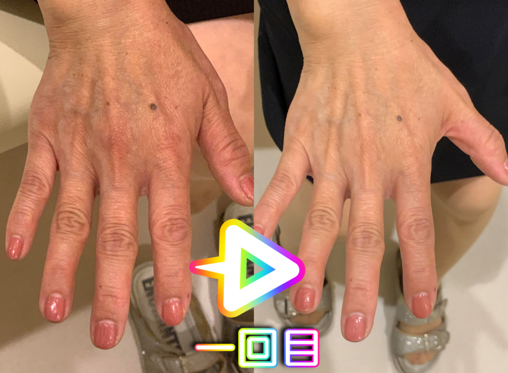 光エステ(フォト)施術例｜50代女性｜脱毛＆光サロンone-shot(ワンショット) 徳島市の脱毛＆光エステサロン