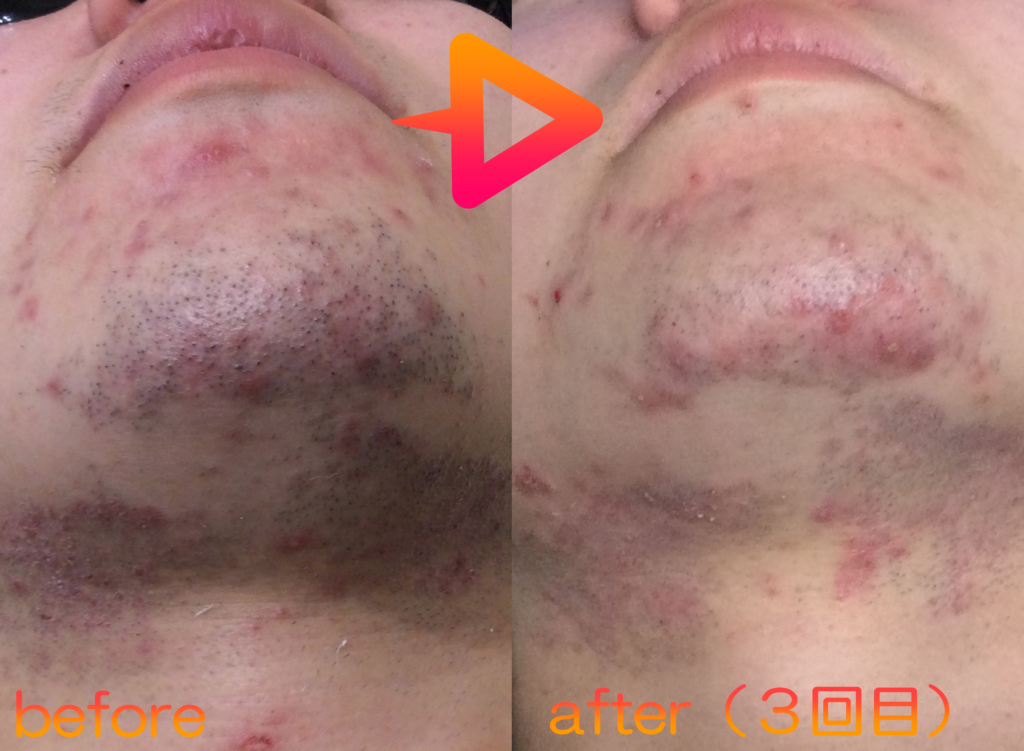 脱毛施術例｜10代男性ヒゲ脱毛｜one-shot(ワンショット) 徳島市の脱毛＆光エステサロン