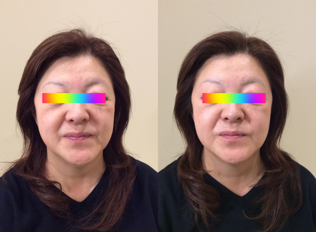 光エステ(フォト)施術例｜60代女性｜脱毛＆光サロンone-shot(ワンショット) 徳島市の脱毛＆光エステサロン