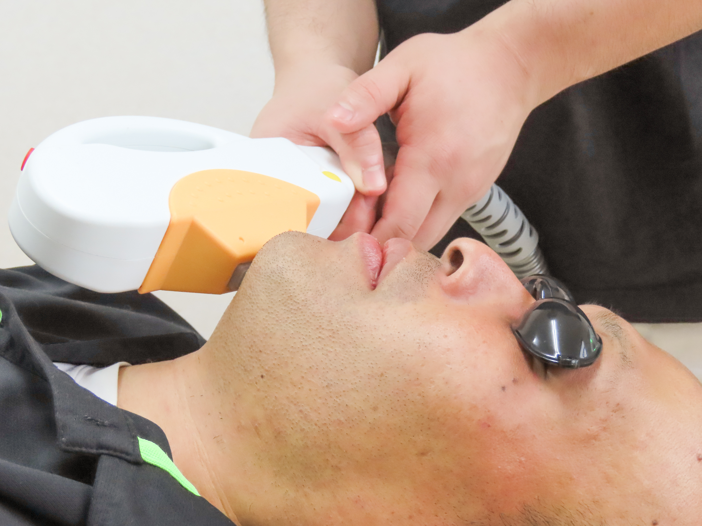 ヒゲ脱毛｜one-shot(ワンショット) 徳島市の脱毛＆光エステサロン