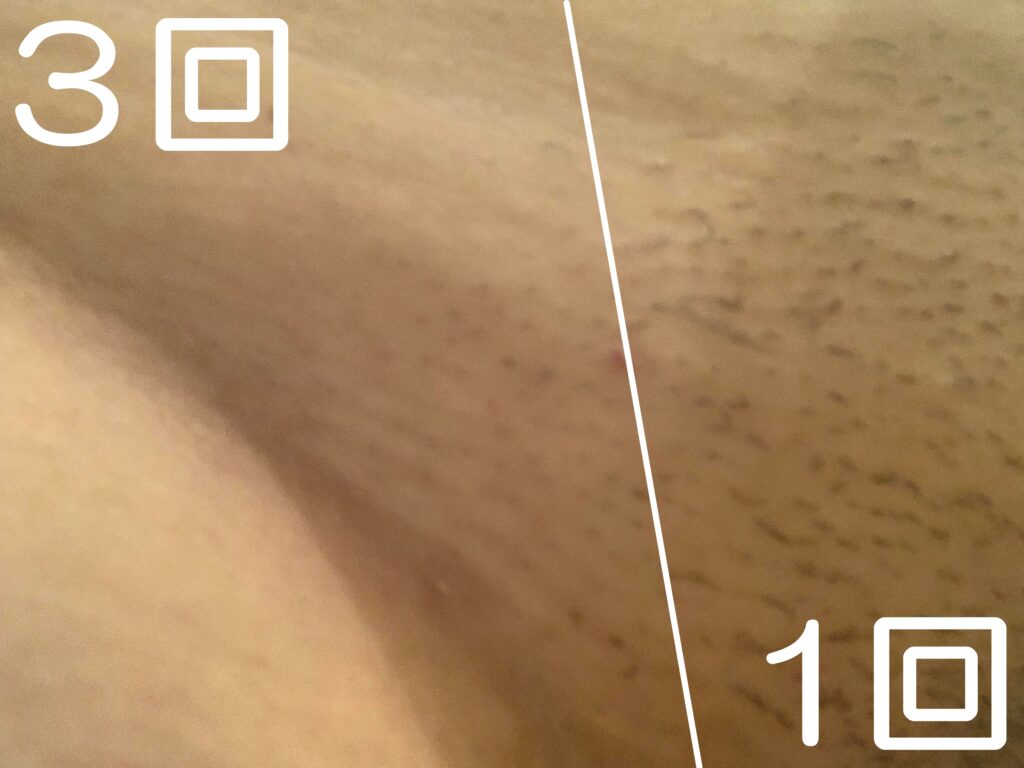 脱毛施術例｜50代女性Vライン脱毛｜one-shot(ワンショット) 徳島市の脱毛＆光エステサロン