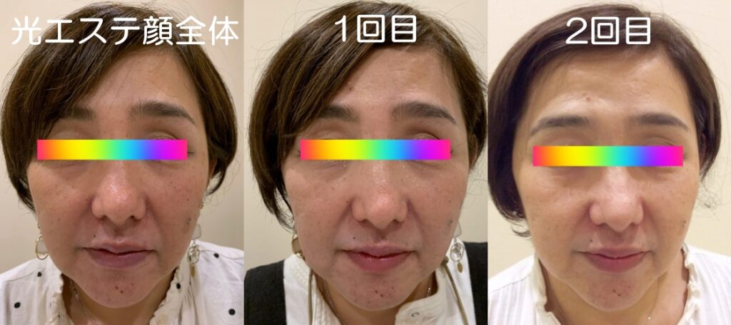 光エステ(フォト)施術例｜50代女性｜脱毛＆光サロンone-shot(ワンショット) 徳島市の脱毛＆光エステサロン