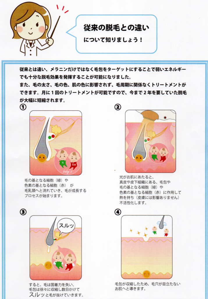 従来の脱毛との違い　one-shot(ワンショット) 徳島市の脱毛＆光エステサロン