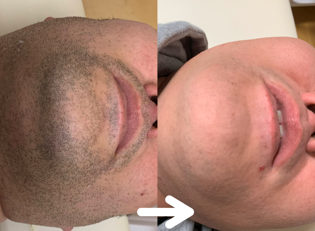脱毛施術例｜40代男性ヒゲ脱毛｜one-shot(ワンショット) 徳島市の脱毛＆光エステサロン