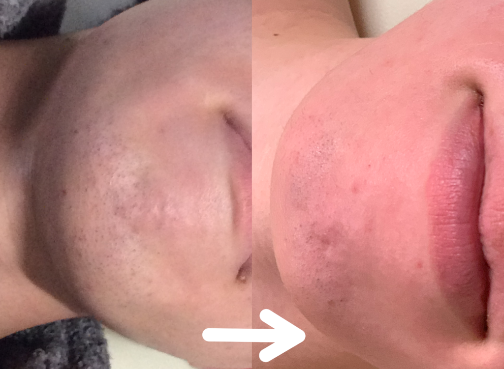 脱毛施術例｜20代男性ヒゲ脱毛｜one-shot(ワンショット) 徳島市の脱毛＆光エステサロン