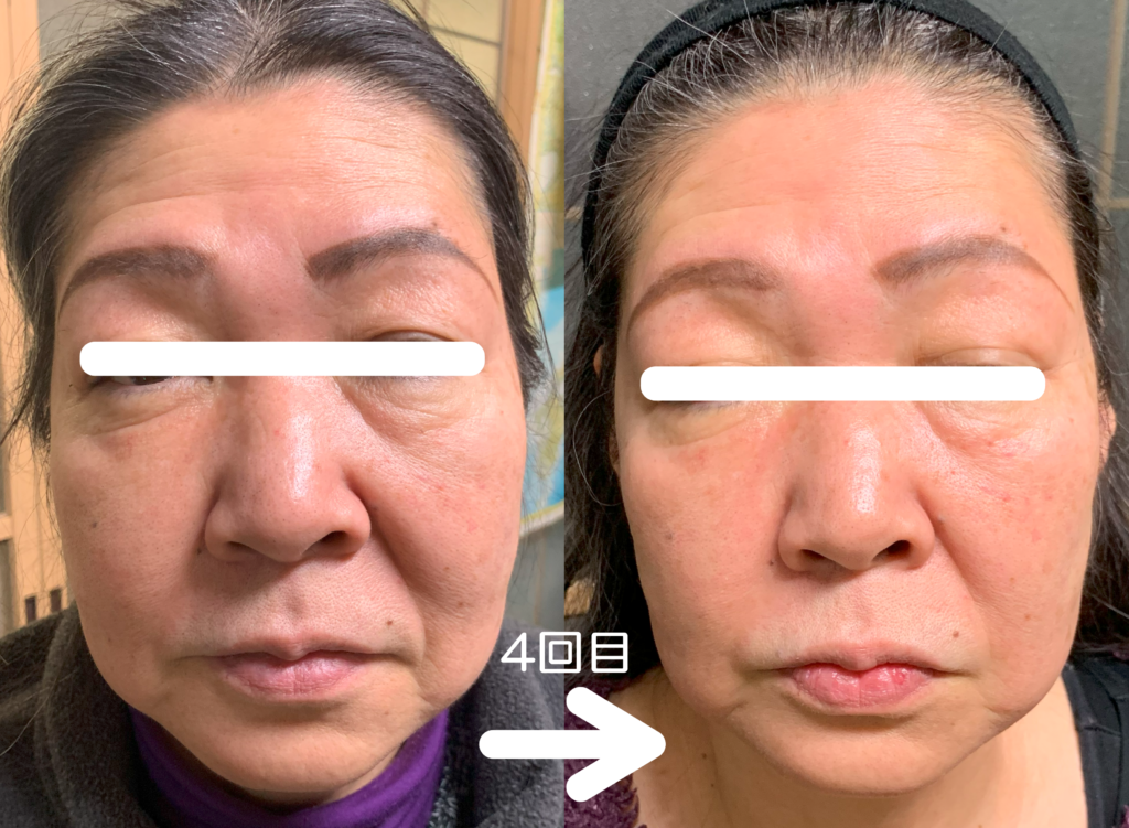 光エステ(フォト)施術例｜50代女性｜たるみ4回施術
