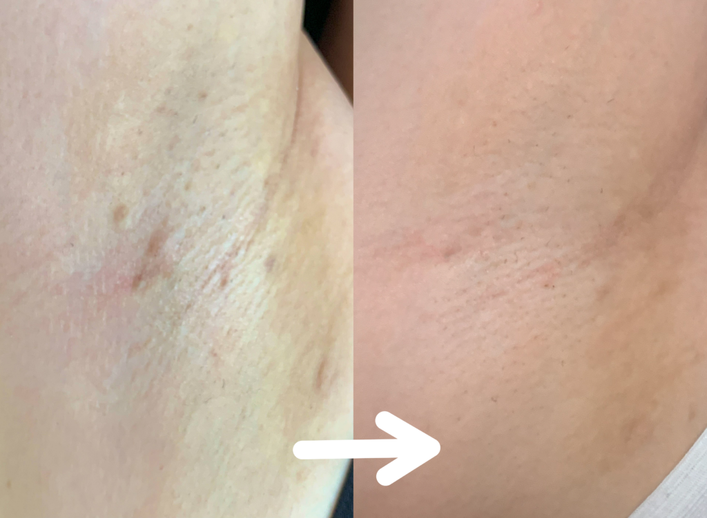 脱毛施術例｜20代女性ワキ脱毛｜one-shot(ワンショット) 徳島市の脱毛＆光エステサロン