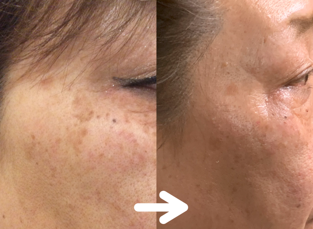 光エステ(フォト)施術例｜50代女性｜