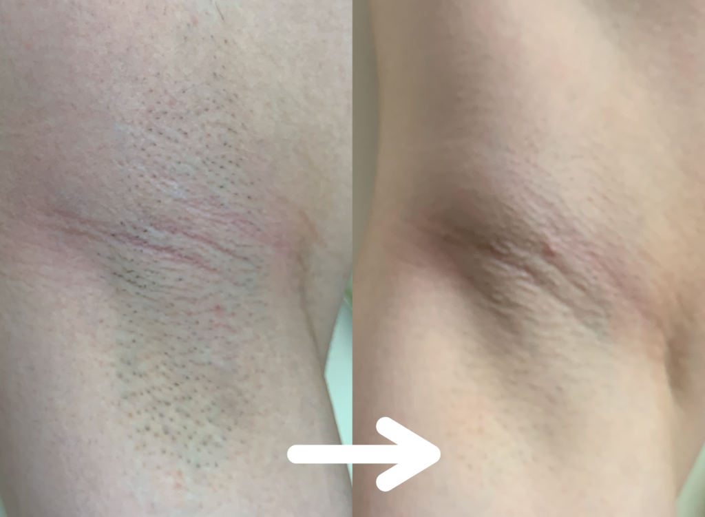 脱毛施術例｜20代男性ワキ脱毛｜one-shot(ワンショット) 徳島市の脱毛＆光エステサロン