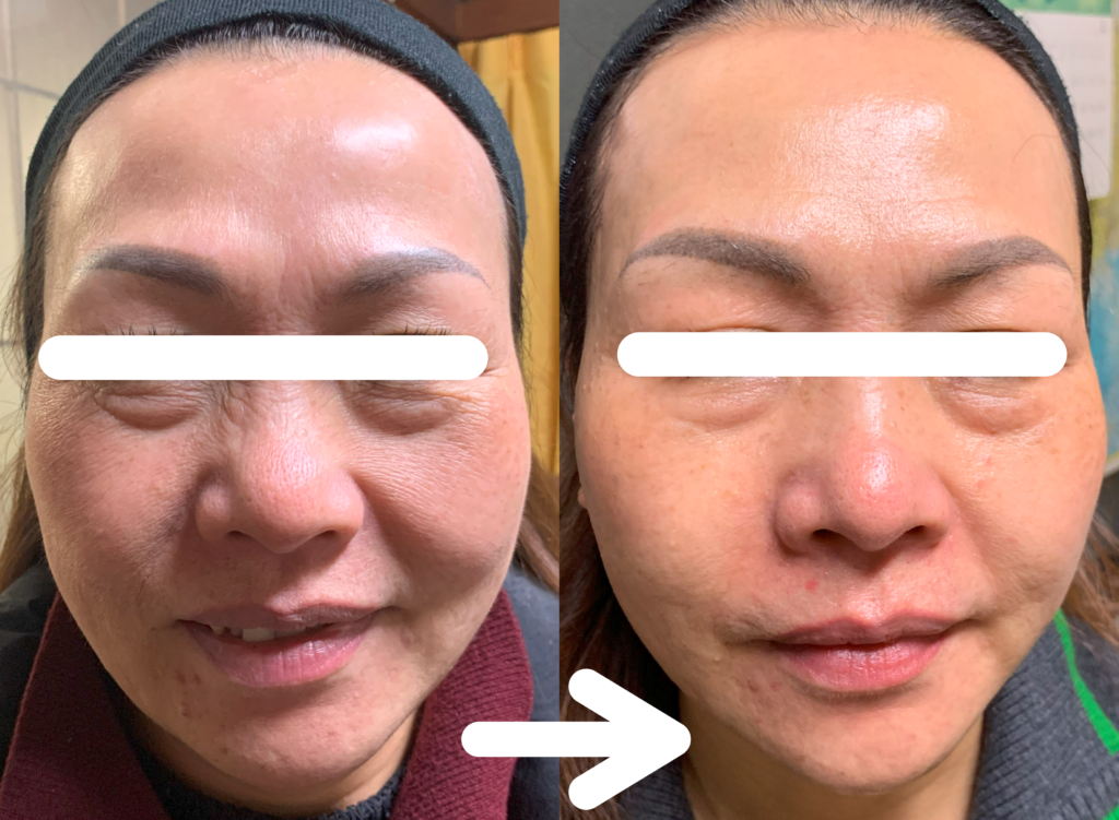 光エステ(フォト)施術例｜50代女性｜しわ、たるみ、ほうれいせん２回施術