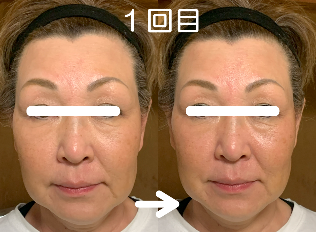 光エステ(フォト)施術例｜60代女性｜脱毛＆光サロンone-shot(ワンショット) 徳島市の脱毛＆光エステサロン｜１回目正面