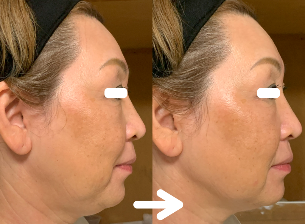 光エステ(フォト)施術例｜60代女性｜１回目右｜脱毛＆光サロンone-shot(ワンショット) 徳島市の脱毛＆光エステサロン